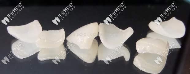 emax是鑄瓷貼面