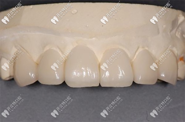 門牙瓷貼面的適應(yīng)證和優(yōu)點