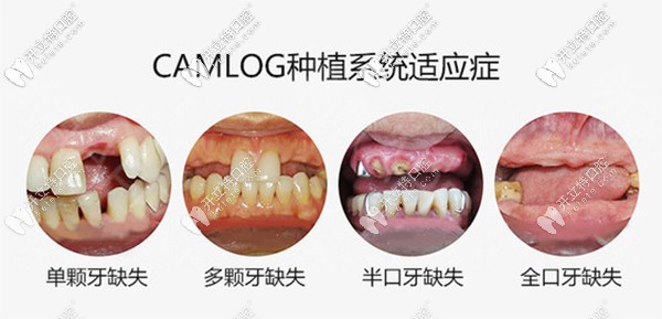 德國Camlog種植體適應(yīng)癥