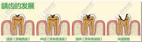 齲病的發(fā)展