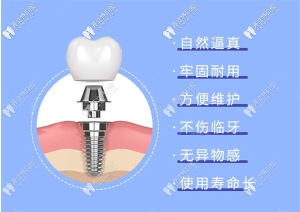 國產(chǎn)種植體cdic真的不錯