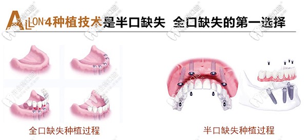 北京市朝陽區(qū)維樂做allon4速導半口種植牙價格是多少？