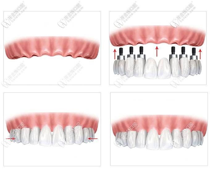 半口半固定種植牙牢固