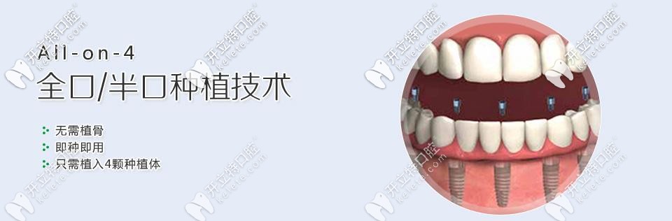 韓國(guó)奧齒泰種植系統(tǒng)ALL-ON-4全口種植牙價(jià)格在15萬起