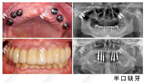 昆明美奧口腔半口種植牙案例