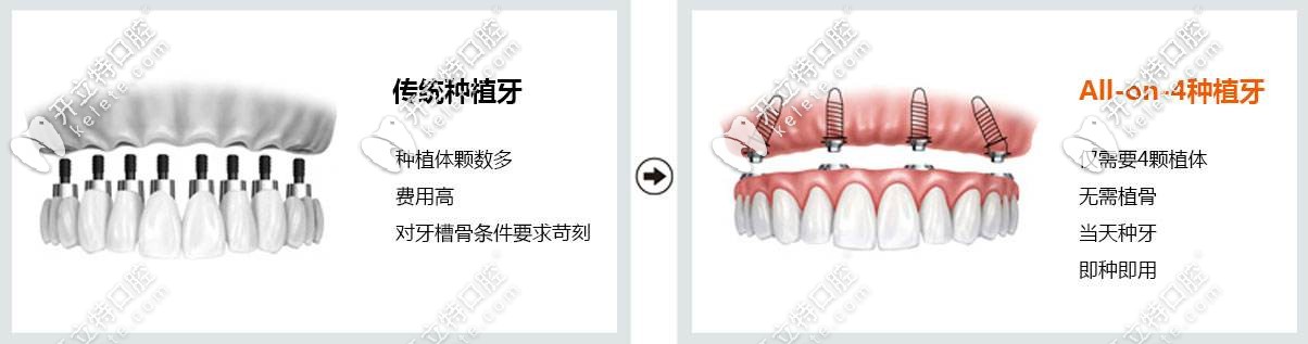 韓系奧齒泰ALL-on-4全口種植牙技術(shù)優(yōu)點(diǎn)