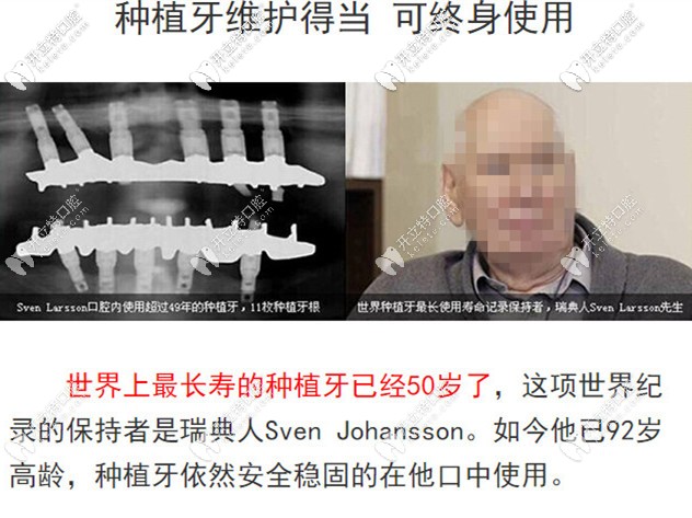 韓國登騰種植牙的壽命