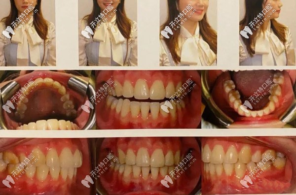 整牙的時(shí)間不長，但是<span style=