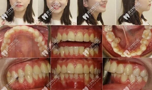 正面、側(cè)面照，記錄牙齒的變化情況