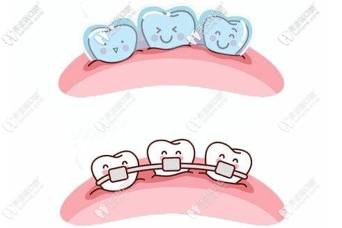 不同的牙套對比