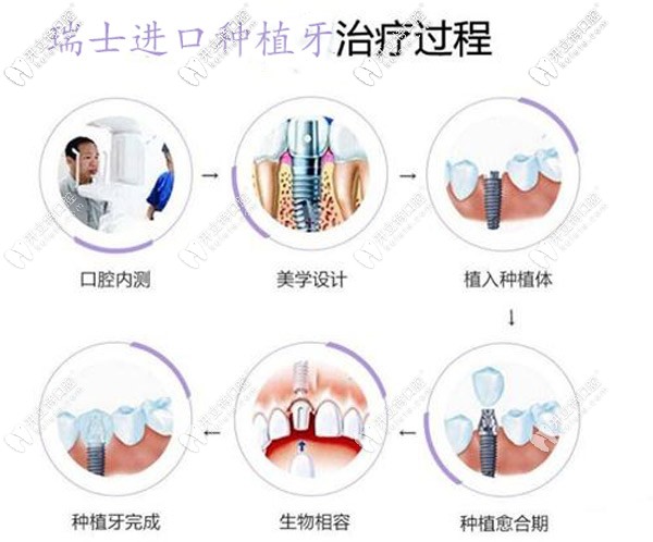 瑞士進(jìn)口種植牙治療過程