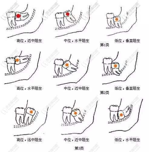 阻生齒類型
