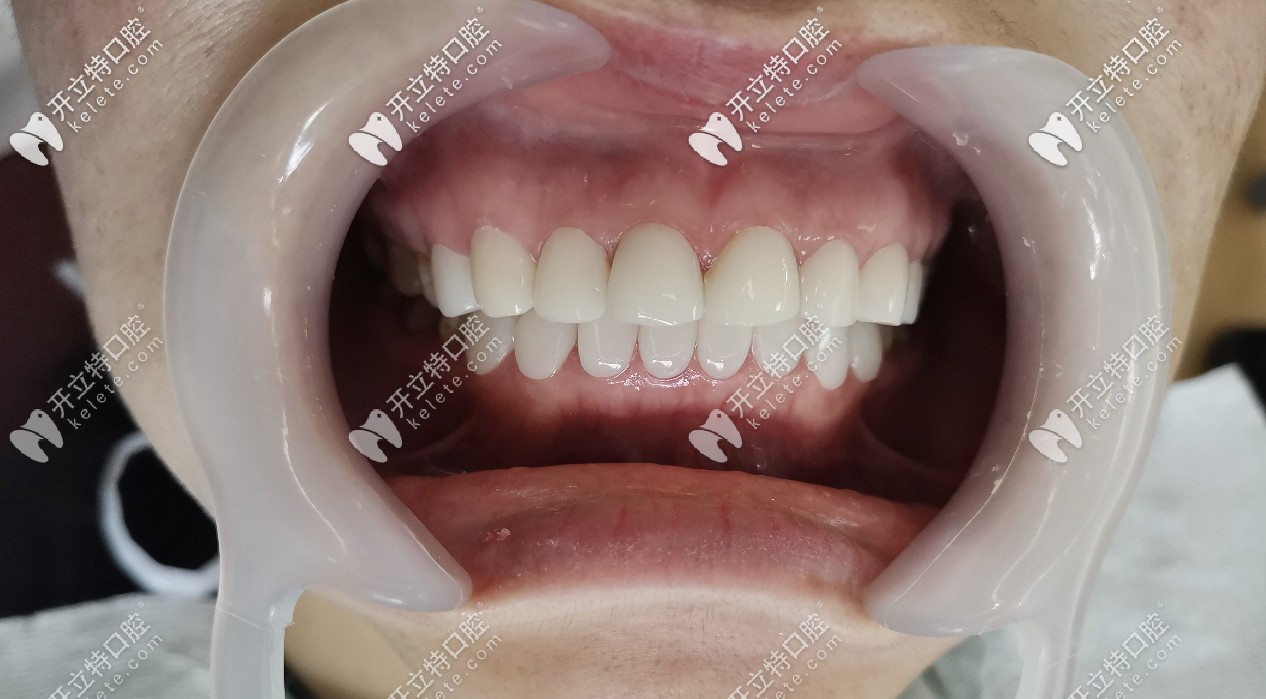 牙齒美白后的圖片