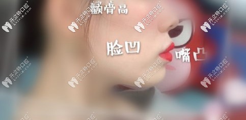 顴骨高、面部凹陷、凸嘴
