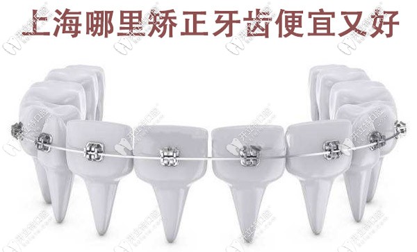上海哪里矯正牙齒便宜又好，這些有名的牙科醫(yī)院值得選擇