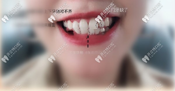 我的牙齒矯正前上下牙中線對不齊