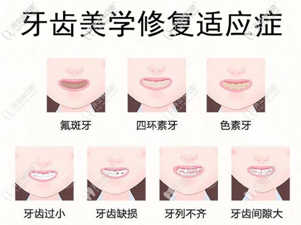 賀州微笑口腔牙齒美學修復適應癥