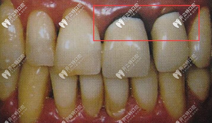 烤瓷牙價(jià)格便宜但容易有牙齦黑線