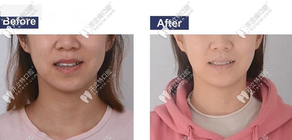 矯正前后臉型對比圖