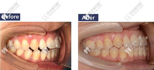 開頜矯正側(cè)面圖