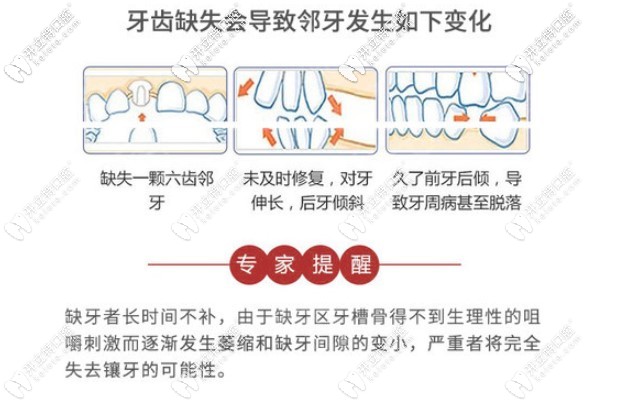 一顆牙齒缺失后可能導致的后果