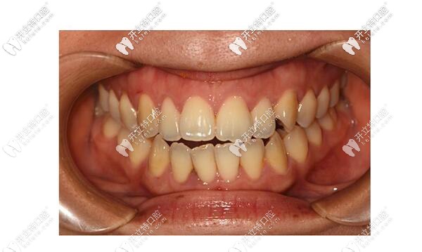 河源恒信口腔牙齒矯正前