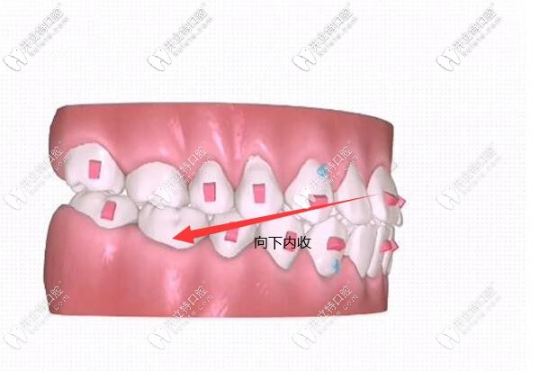 前牙壓低向下內(nèi)收