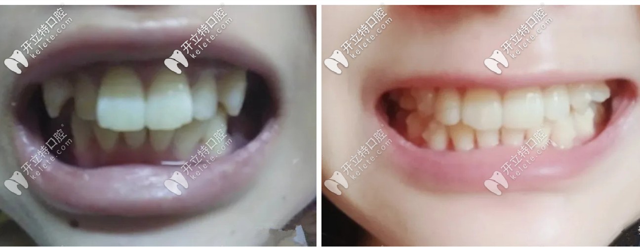 拔了4顆牙后做的隱適美，在濰坊戴隱形牙套的效果還不錯