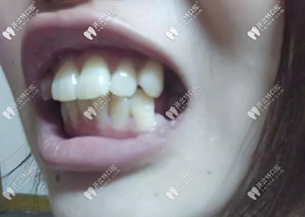 牙齒的側(cè)面照，外凸的厲害