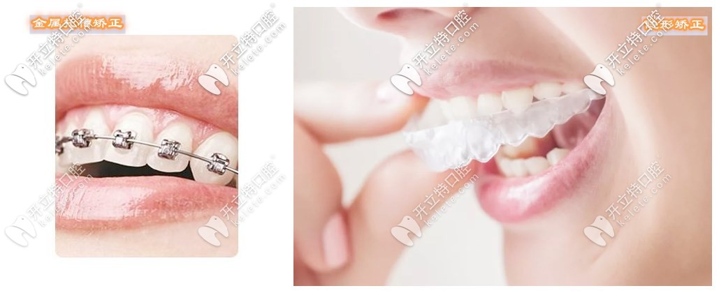 金屬矯正和隱形矯正