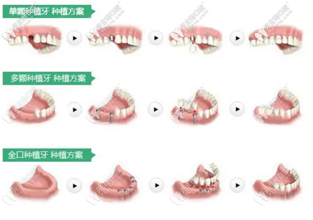 石家莊中諾口腔種植牙團購優(yōu)惠價格活動正在進行中