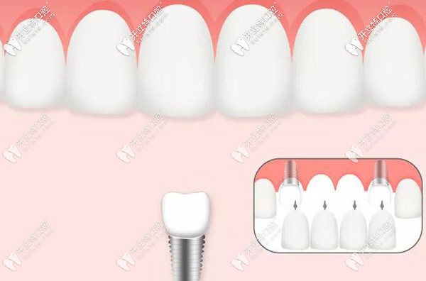 影響種植牙價(jià)格的還有種植技術(shù)