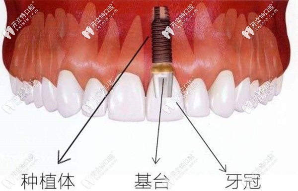 不同種植體品牌會(huì)影響一顆種植牙的價(jià)格