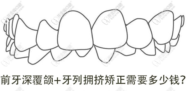 牙列擁擠+深覆合，想矯正牙齒做手術(shù)需要多少錢呢？