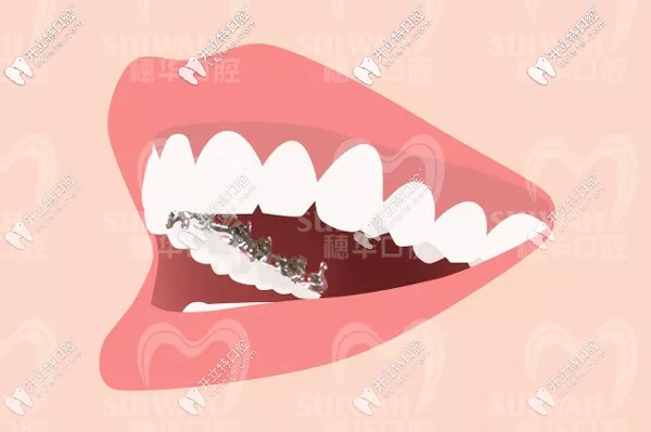 廣州穗華口腔引進3M Incognito黃金舌側矯治系統(tǒng)