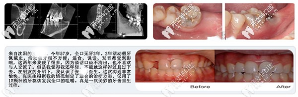 沈陽(yáng)盛大口腔單顆牙缺失案例