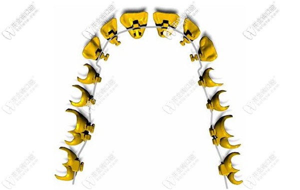 美國3M Incognito黃金舌側隱形矯治器