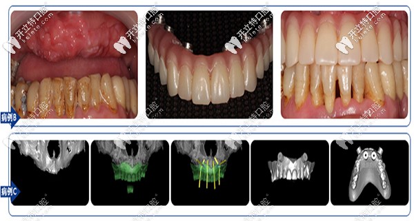 沈陽(yáng)盛大口腔全口、半口缺失案例