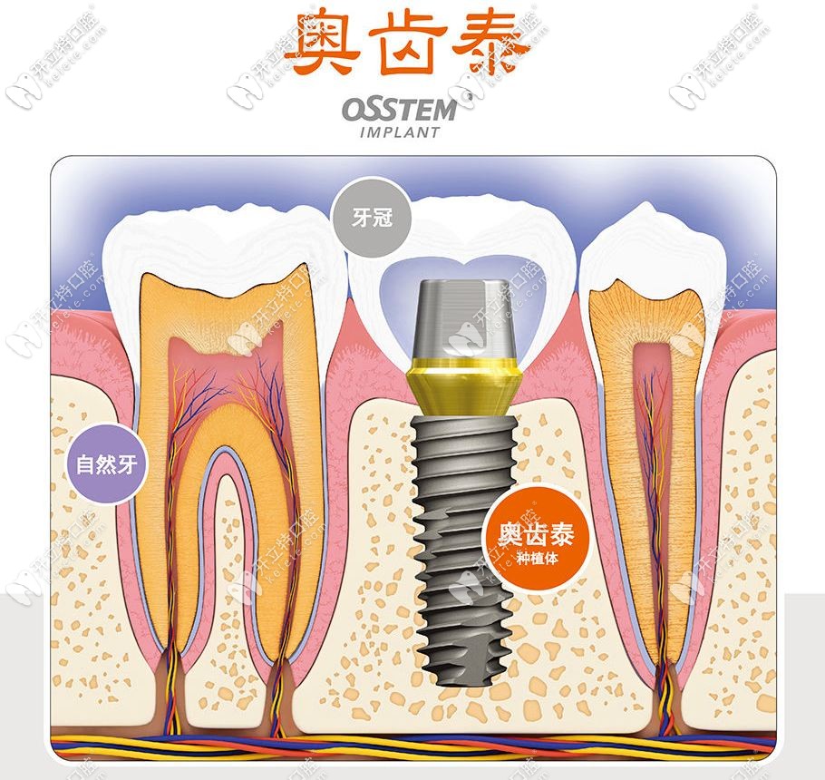 韓國奧齒泰種植牙