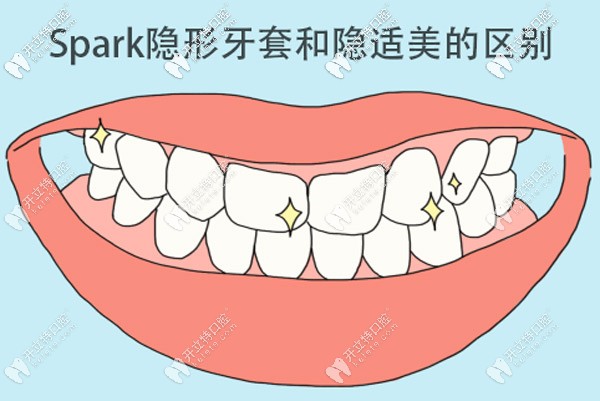 Spark隱形牙套和隱適美哪個好，區(qū)別是什么？