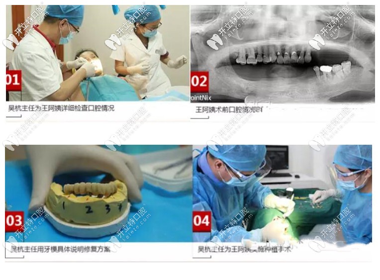 王阿姨做allon4半口種植牙的詳細過程