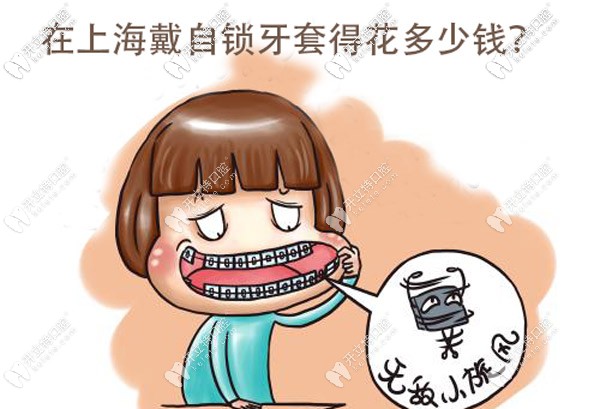 目前在上海戴金屬自鎖牙套的價(jià)格大概是多少？