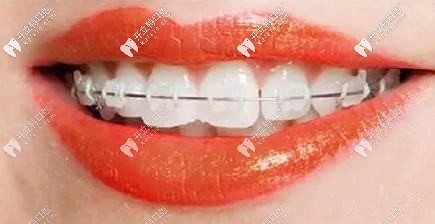 陶瓷半隱形矯正器