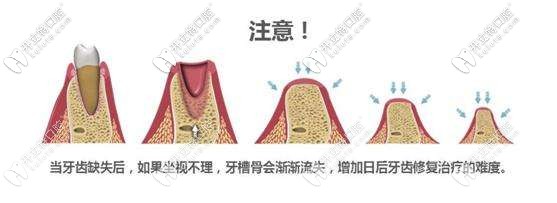 牙槽骨會(huì)日漸萎縮