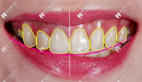 牙齒貼面的方案設(shè)計圖