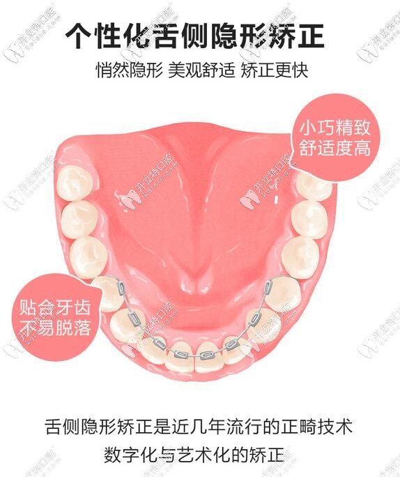 個(gè)性化舌側(cè)矯正的優(yōu)勢(shì)