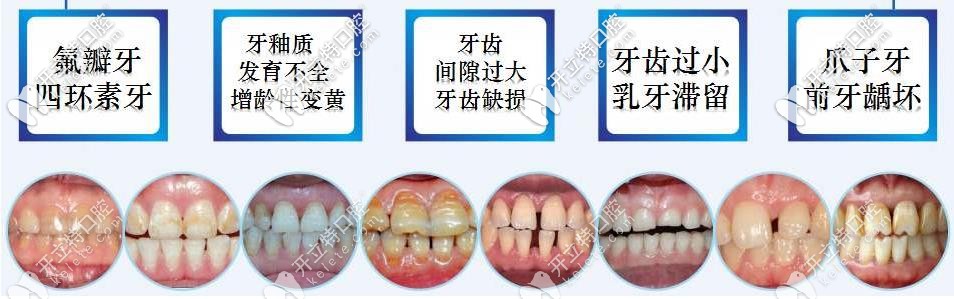 貼面的適用情況