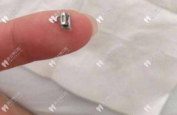 托槽掉了還能再用嗎，該如何處理？