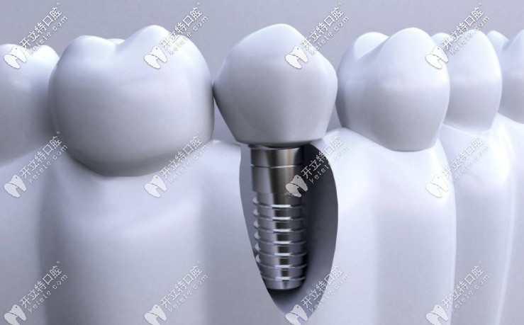 成都種植全口牙的價(jià)格是多少？附種牙醫(yī)生推薦！