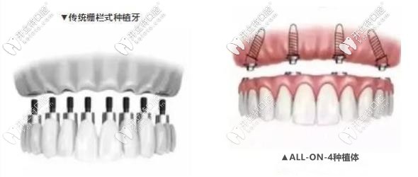 傳統(tǒng)點種和all-on-4種植的區(qū)別